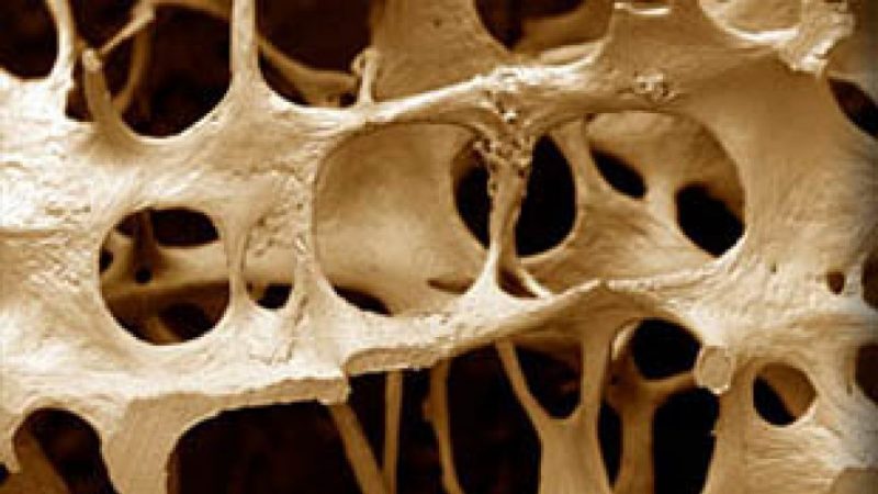 Osteoporosi: ossa fragili